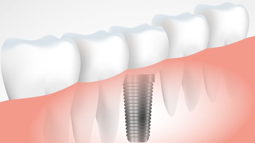 5 Claves para elegir tu implantólogo